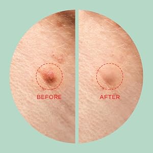 Tea Tree Clear – Dot Patch