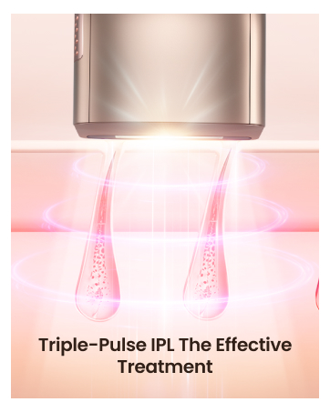Triple-Pulse IPL