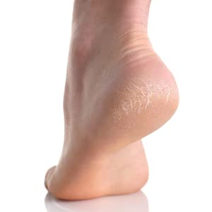 foot file - cracked heels