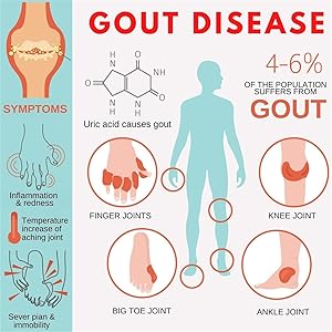 Gout Ointment Herbal Toe Knee Joint Pain Relief Massage Cream pain edema