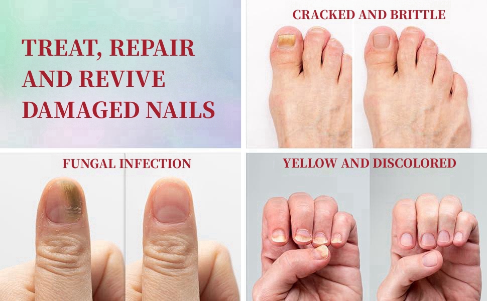 ingrowing toe nail treatment ingrowing toenail ingrowing toenail plasters ingrown toenail remover