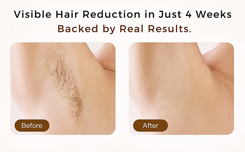 IPL LASER HAIR REMOVAL 