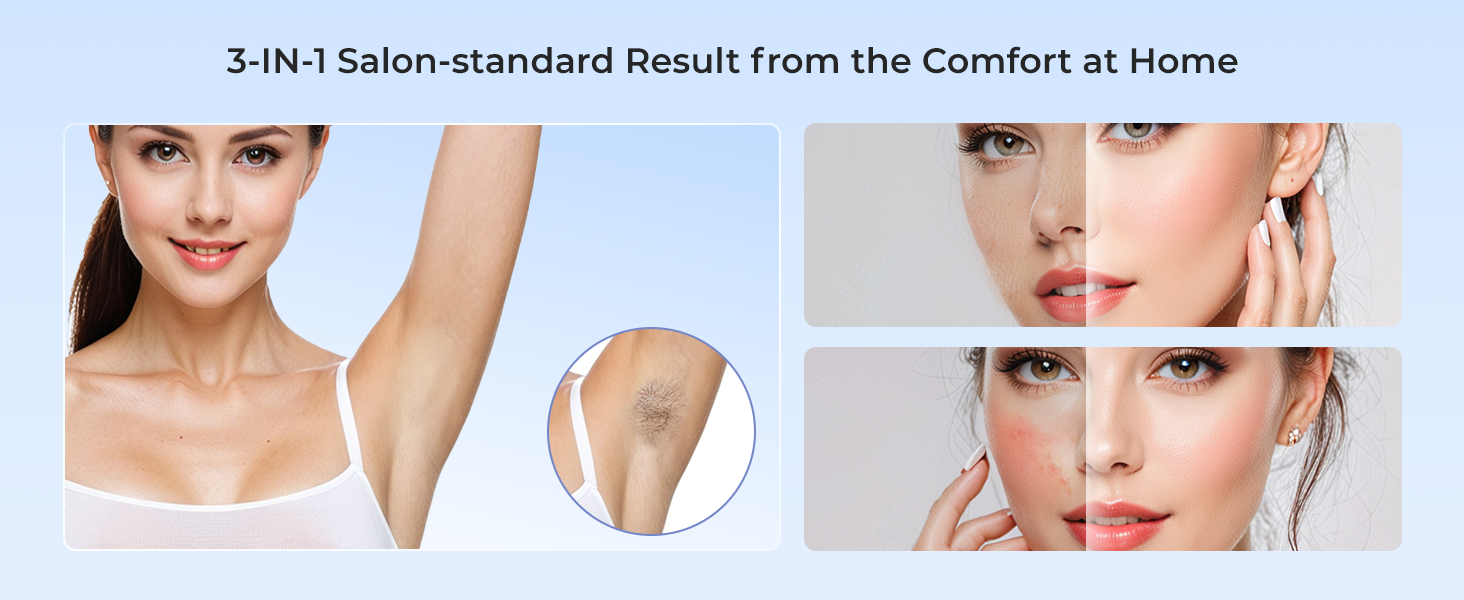 laser hair removal device