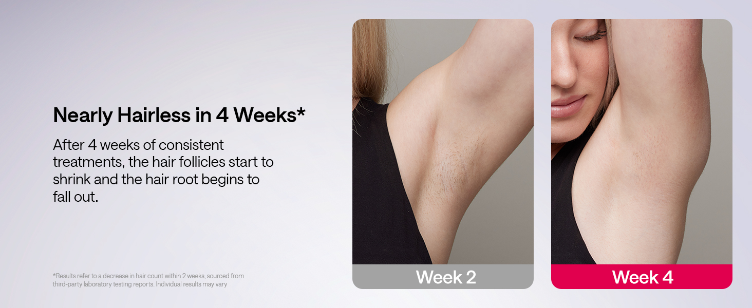  Laser Hair Removal Device
