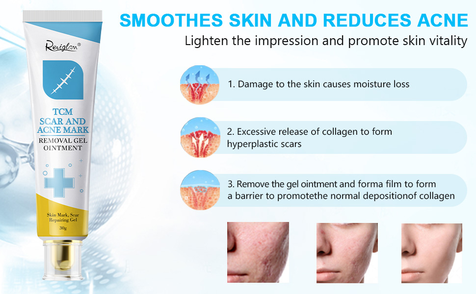 stretch marks removal