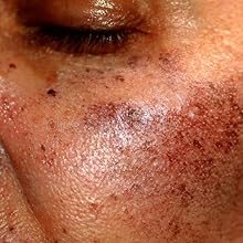 Dark Spot on face mocha glow