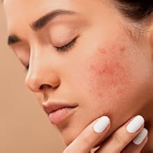 Reduces Acne/Scars