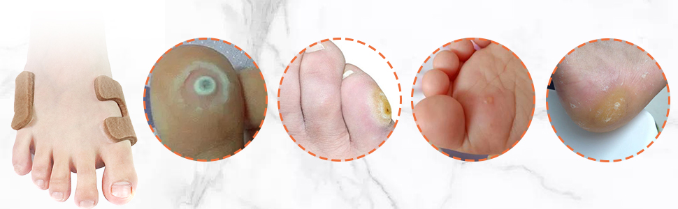 Callus Cushions U-Shaped Callus Pads and Elliptical Foam Corn Pads Set for Foot with Self-Stick