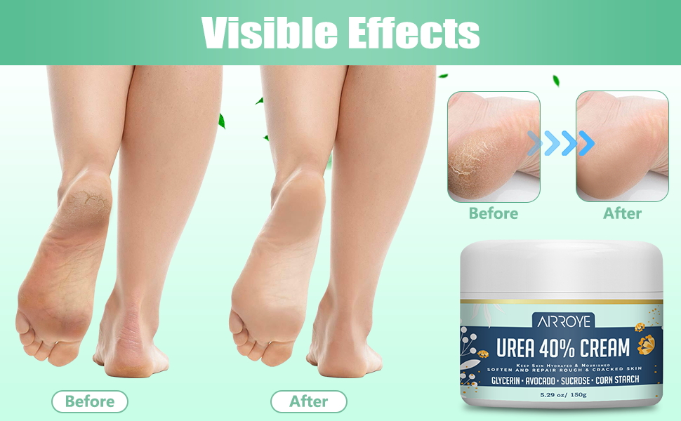 Urea Cream 40% for feet