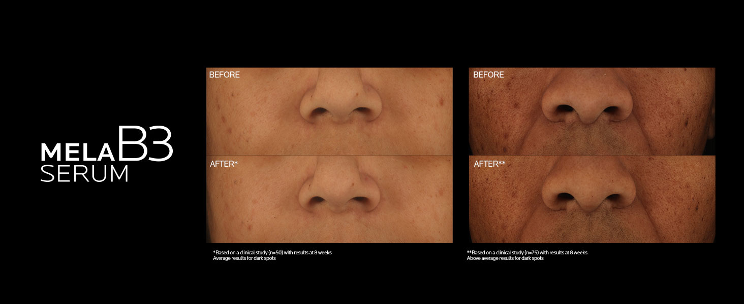 La RochePosay Mela B3 Serum, Dark Spot Corrector With AntiAging Melasyl + 10