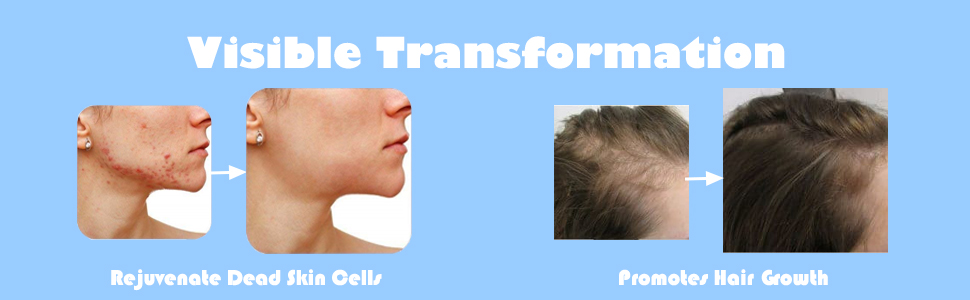 Derma Roller 0.25 MM Cosmetic Microdermabrasion instrument with 540 Titanium Micro needles