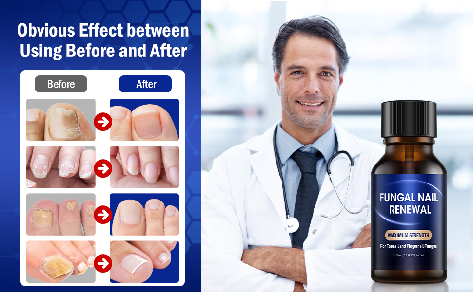 Toe Nail Fungus Treatment