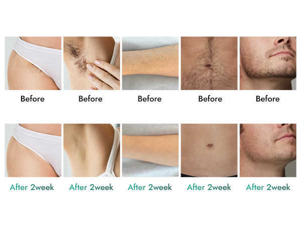Amazon.com: Laser Hair Removal for Women and Men, IPL Laser