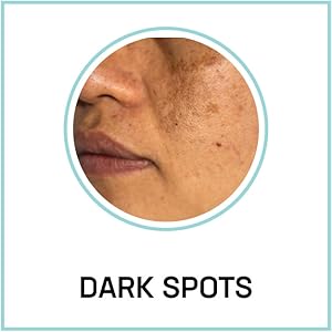 dark spots