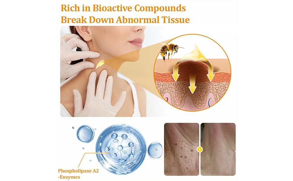 Amazon.com : Beneture Bee Venom Skin Removal Cream,Maximum Strength - Does Bee Venom Work To Remove Skin Tags