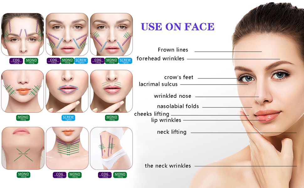 ROCESA Pdo Mono Screw Threads Lift Face Whole Body Mono