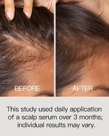  Rosemary Hair Thickening Serum with Biotin, Caffeine for Hair Thinning & Shedding