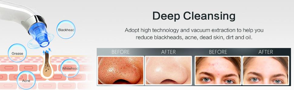 blackhead remover