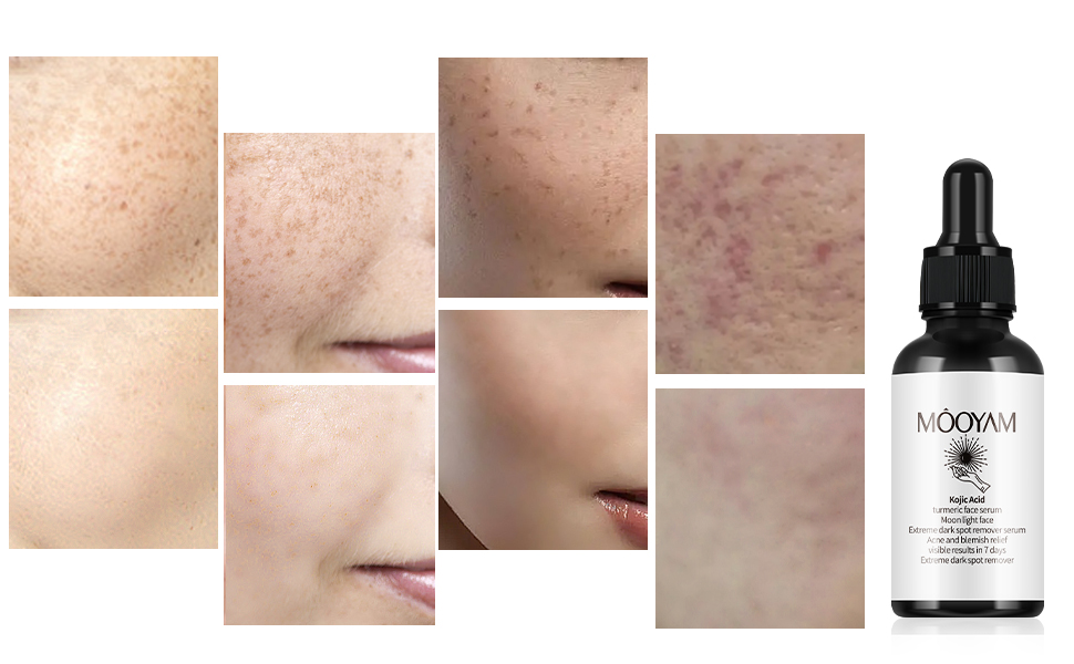 Dark Spot Remover Serum for Face