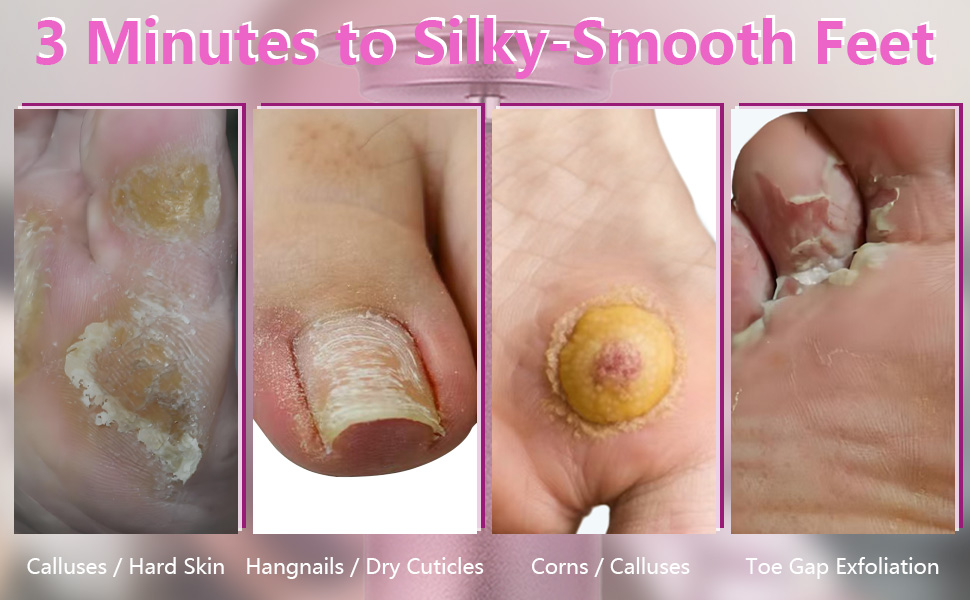 Foot Callus Remover for FootHealth
