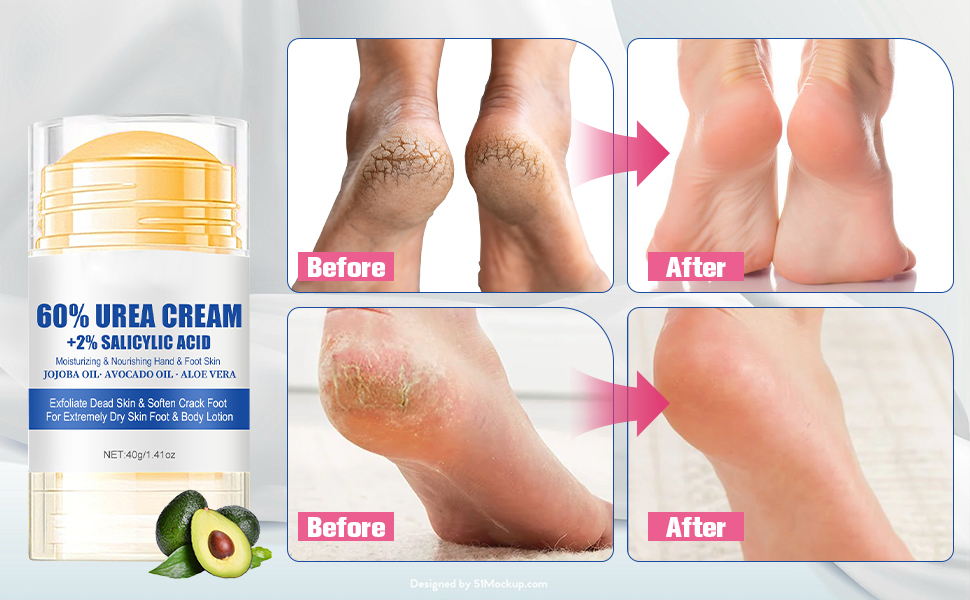 60% Urea Hydrating and Anti-Cracking Foot Cream
