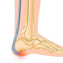 Improve heel pain