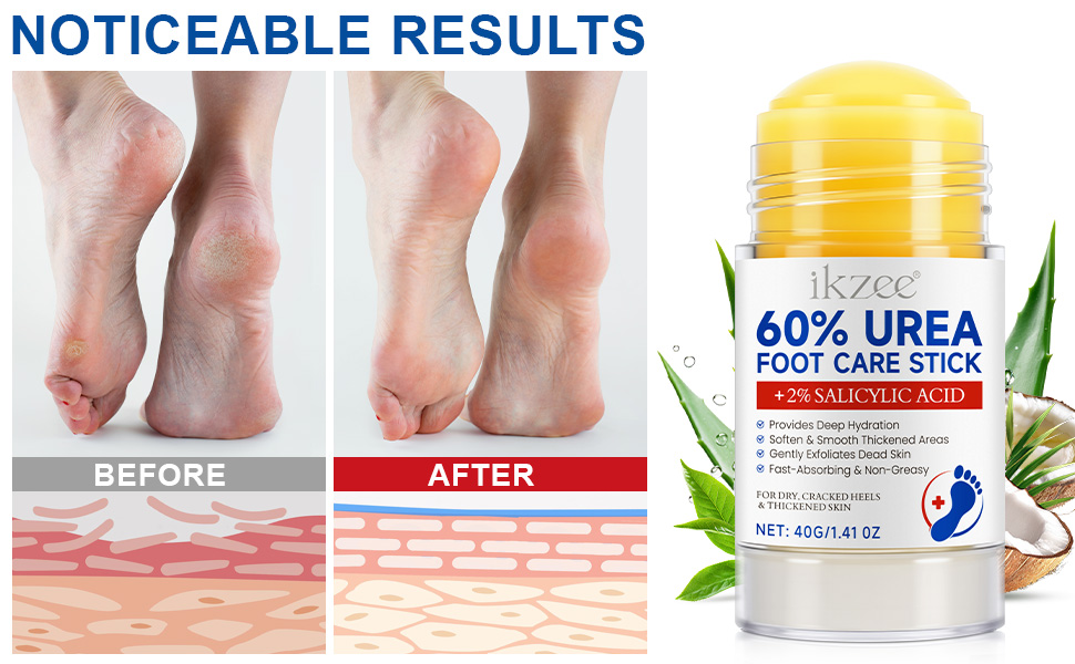 Urea Cream Stick 60% plus 2% Salicylic Acid for Feet Maximum Strength