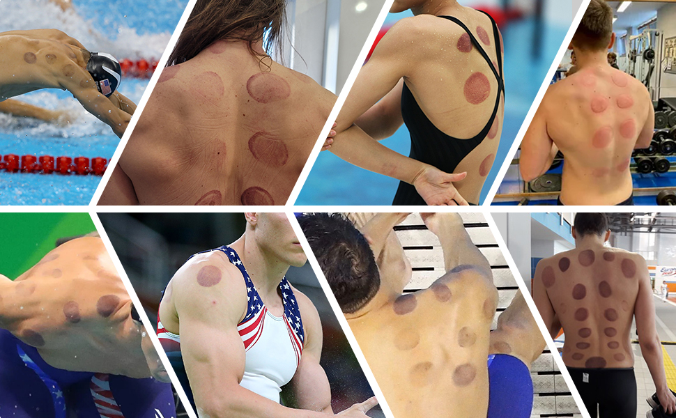 Smart Dynamic Cupping Device