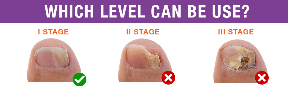 Toenail Fungus Treatment Extra Strength04