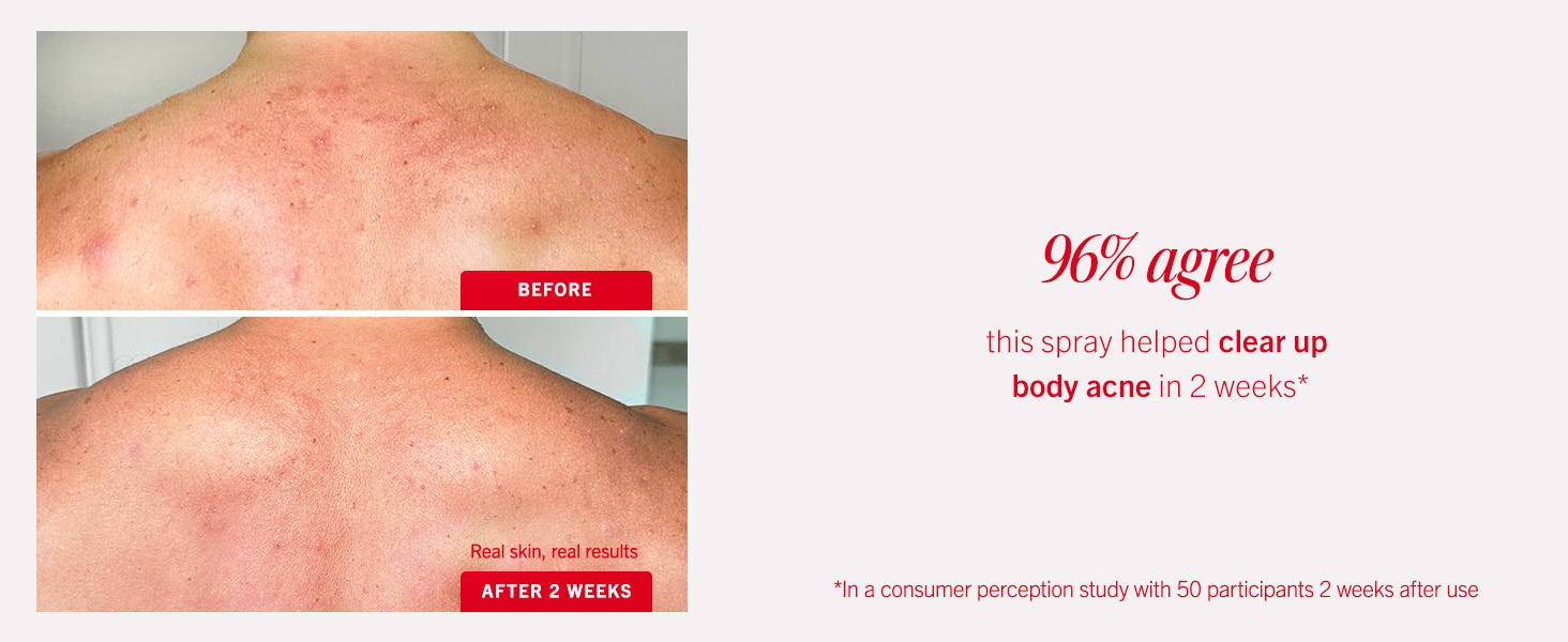 body acne, spray, mist, clearing mist
