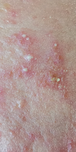 acne led face mask light therapy