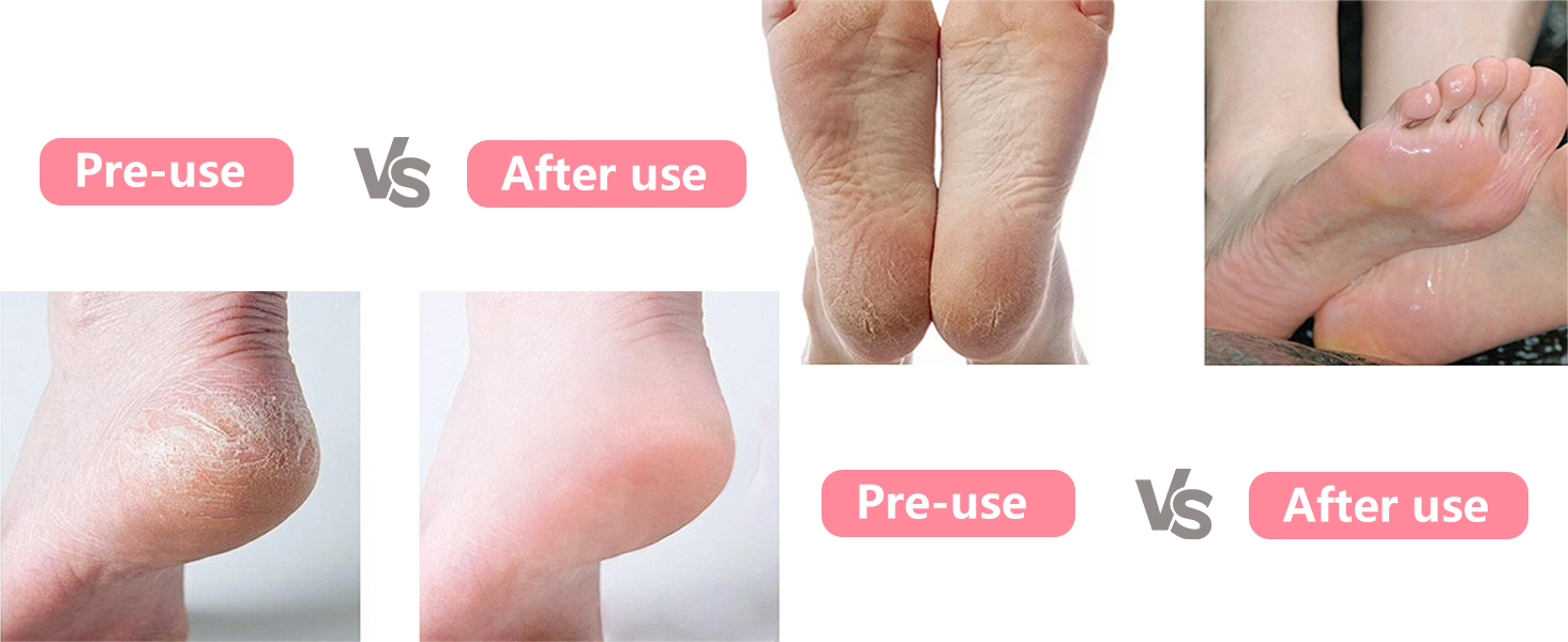 foot file callus remover