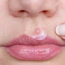microdart pimple patches