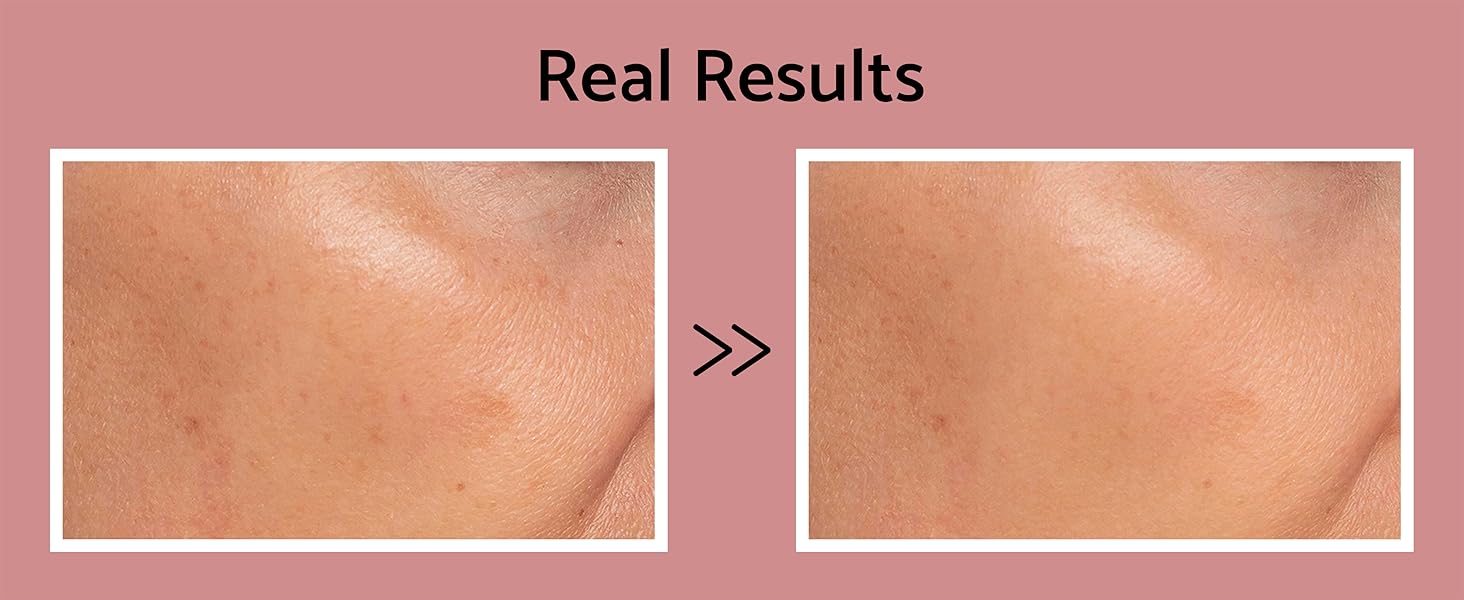 Korean Facial Skincare to Treat Dark Spots Hyperpigmentation Discoloration Uneven Texture Dullness