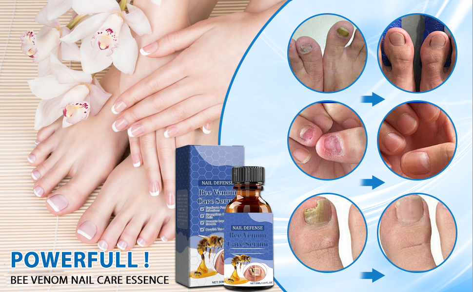 Toenail Fungus Treatment