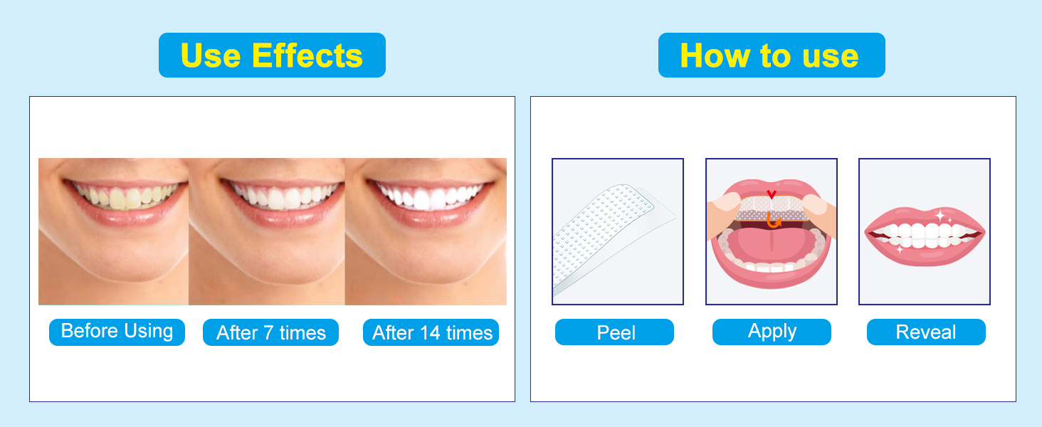 peroxide teeth whitening