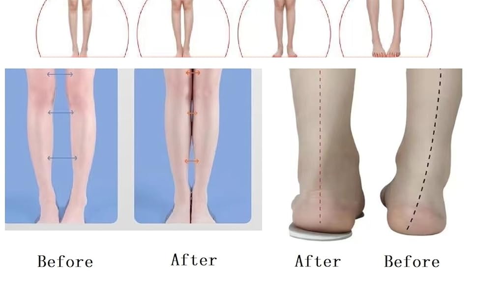 Supination Relief Foot Alignment