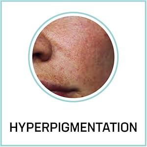 hyperpigmentation 