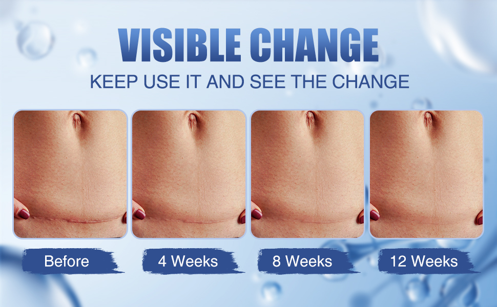 scar cream for surgical scars