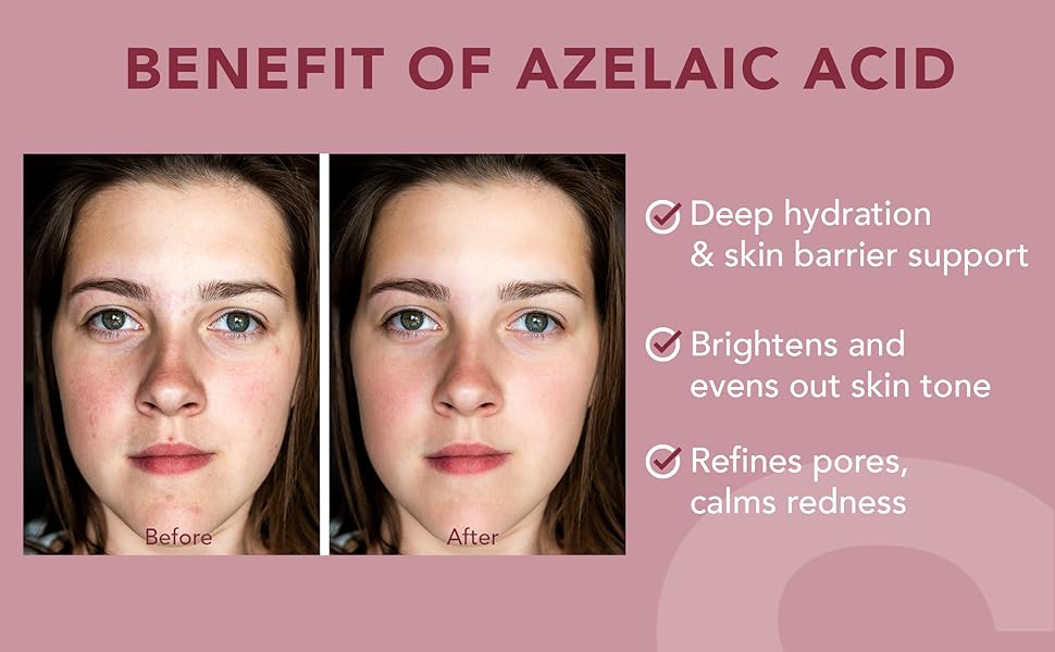 azelaic acid serum