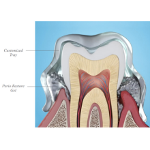 gum trays tray treat perio