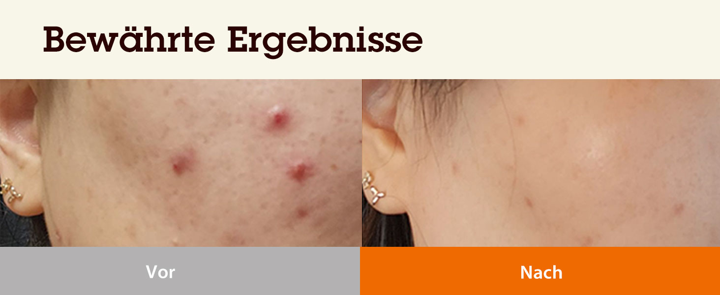 BLITHE Niacinamide 5% + Tranexamic Acid 3% Serum - Dunkle-Flecken-Korrektor, Gesichtsaufhellend, Vitamin B3, Hautberuhig 316c0384 04ba 4b49 9326 B3d226905647. CR0,0,1464,600 PT0 SX1464 V1