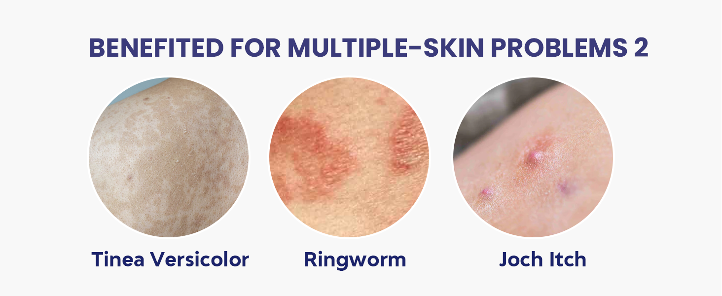 Tinea Versicolor Ringworm Joch Itch