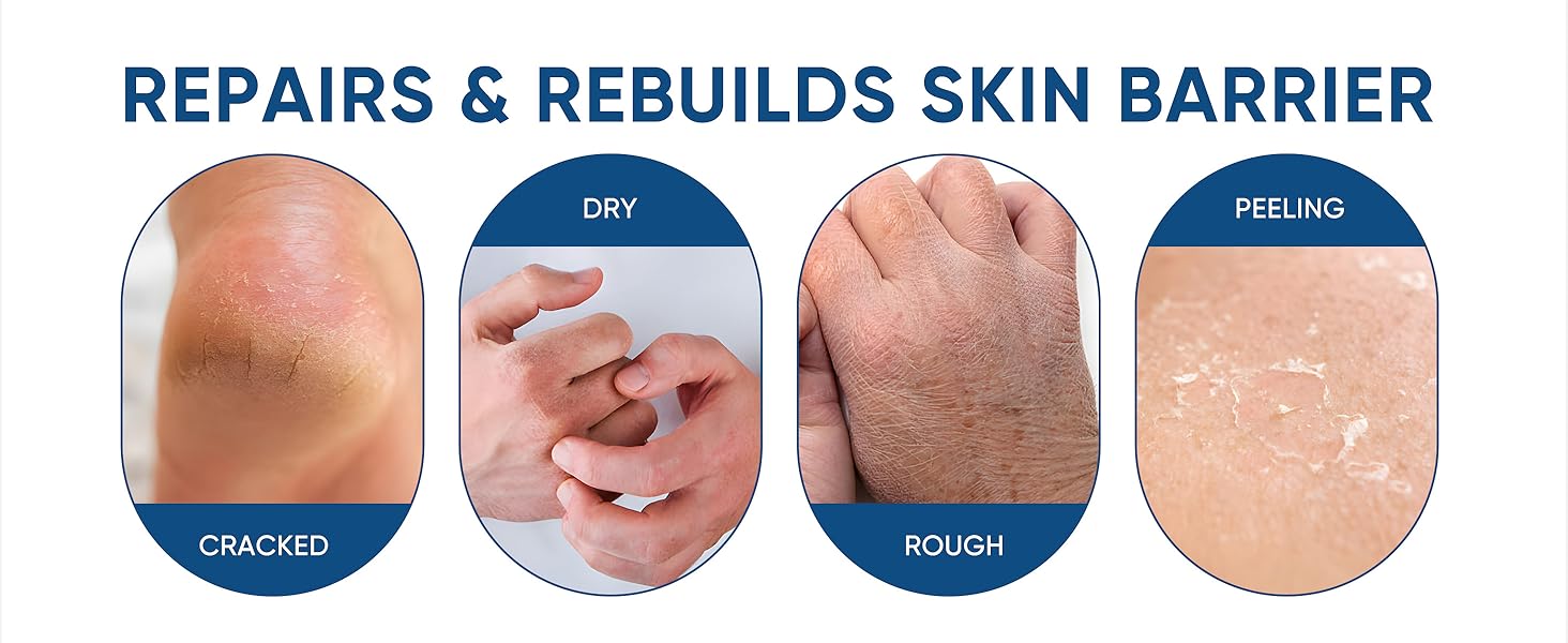 CRACKED DRY ROUGH PEELING