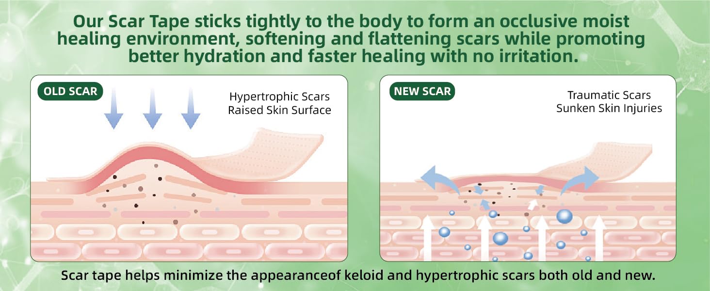 Silicone Scar Sheets