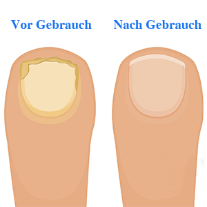 Vergleich der Füße vor und nach der Verwendung von Laserbehandlungsgeräten