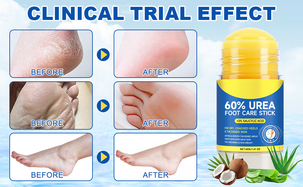 60% Urea with 2% Salicylic Acid Urea Foot Care Stick