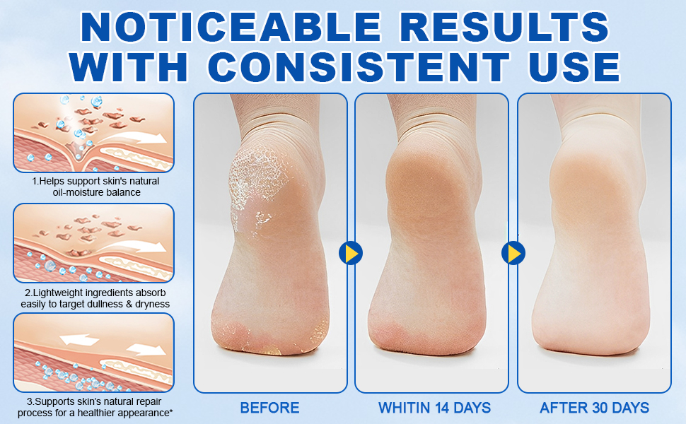 60% Urea with 2% Salicylic Acid Urea Foot Care Stick
