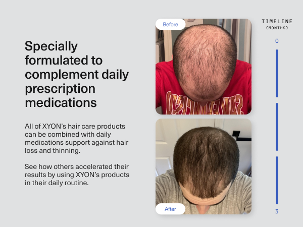 Amazon.com: XYON Defend Hair & Scalp Serum | Men's | Scalp