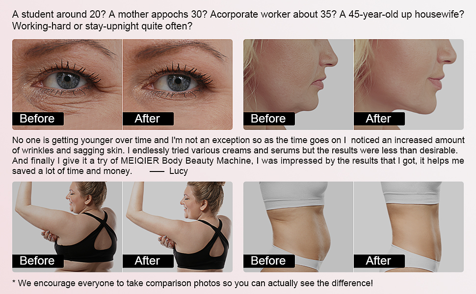 Cellulite Body Device